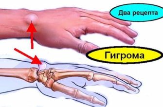 Простые способы снятия боли при артрите плечевого сустава