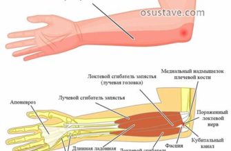 Симптомы боли в суставах локтей - причины и диагностика