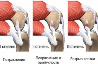 Лекарство Мукосат - эффективное средство при болях в суставах