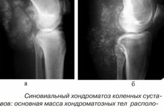 Как использование лейкопластыря помогает справиться с болями в суставах