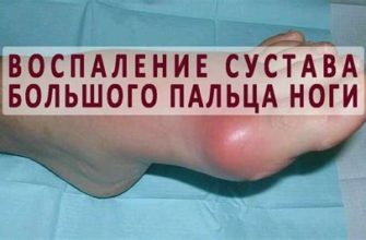 Эффективные мази для лечения боли в плечевом суставе