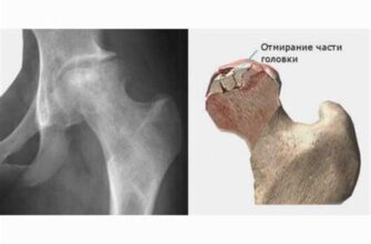 Боль в суставах при фарингите - связь и проявления