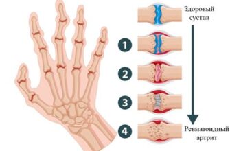 Хроническая боль во всех суставах - симптомы, причины и лечение