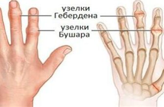 Мелкие суставы - источник боли и путеводитель по лечению