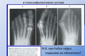 Почему после сна болят суставы рук?